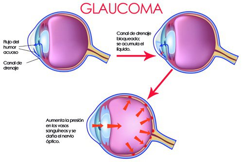 glaucoma-marihuana